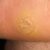 Inspirational How Do I Know If I Have A Planters Wart Ideas
