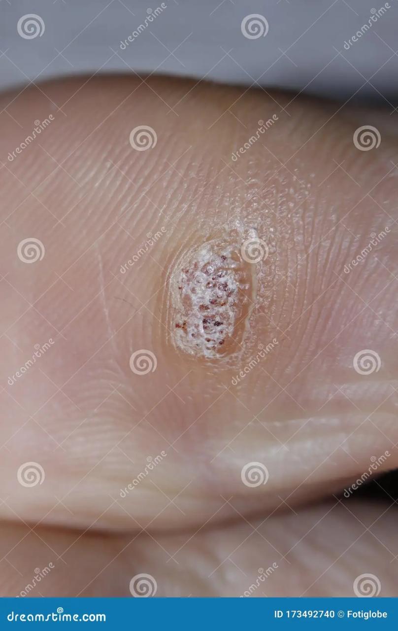 Plantar Wart On Big Toe. Visible Black Dots Warts. RoyaltyFree Stock