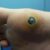 Best Planters Wart On Foot Pictures Ideas