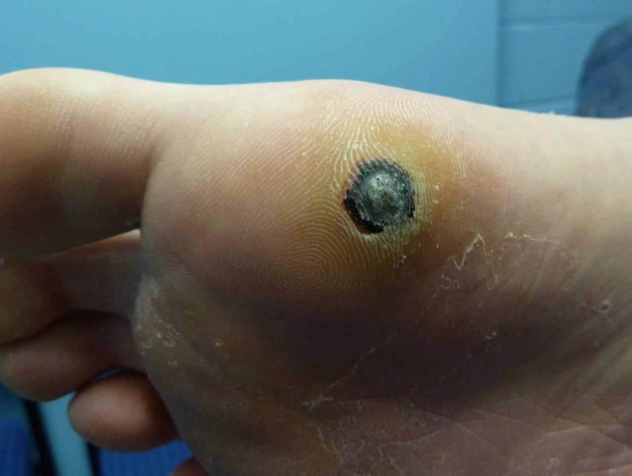 Plantar Warts