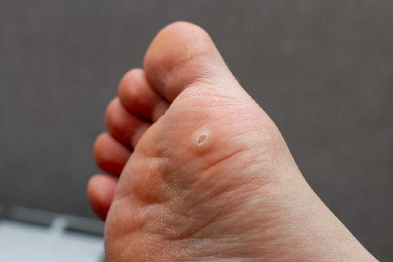 Plantar Warts in Adults & Children — Causes, Treatment, and Prevention
