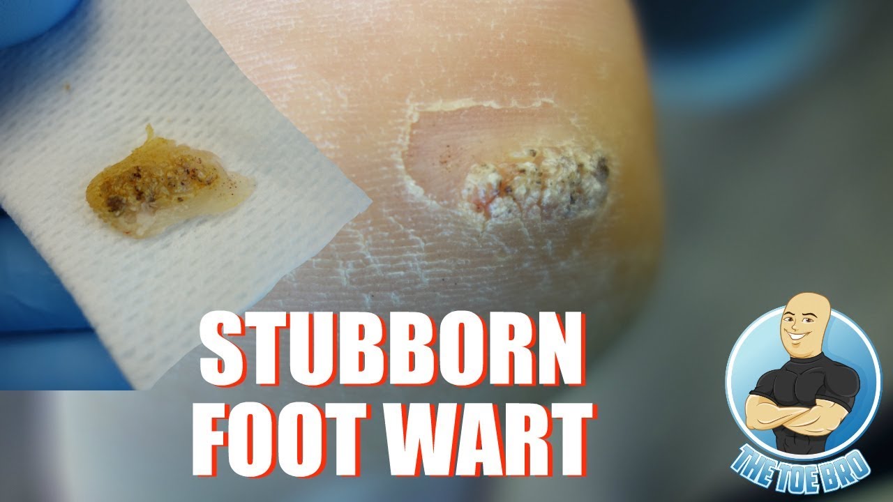 HOW TO TREAT DIFFICULT PLANTAR WARTS REMOVAL FOOT HEALTH MONTH 2018
